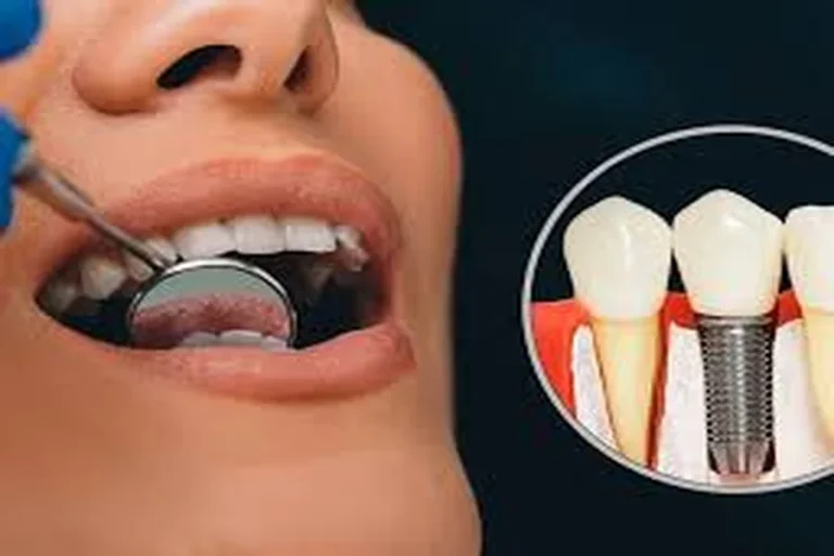 Why Dental Implants in Budapest Are the Best Choice in Europe